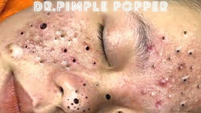 Blackhead Removal 4